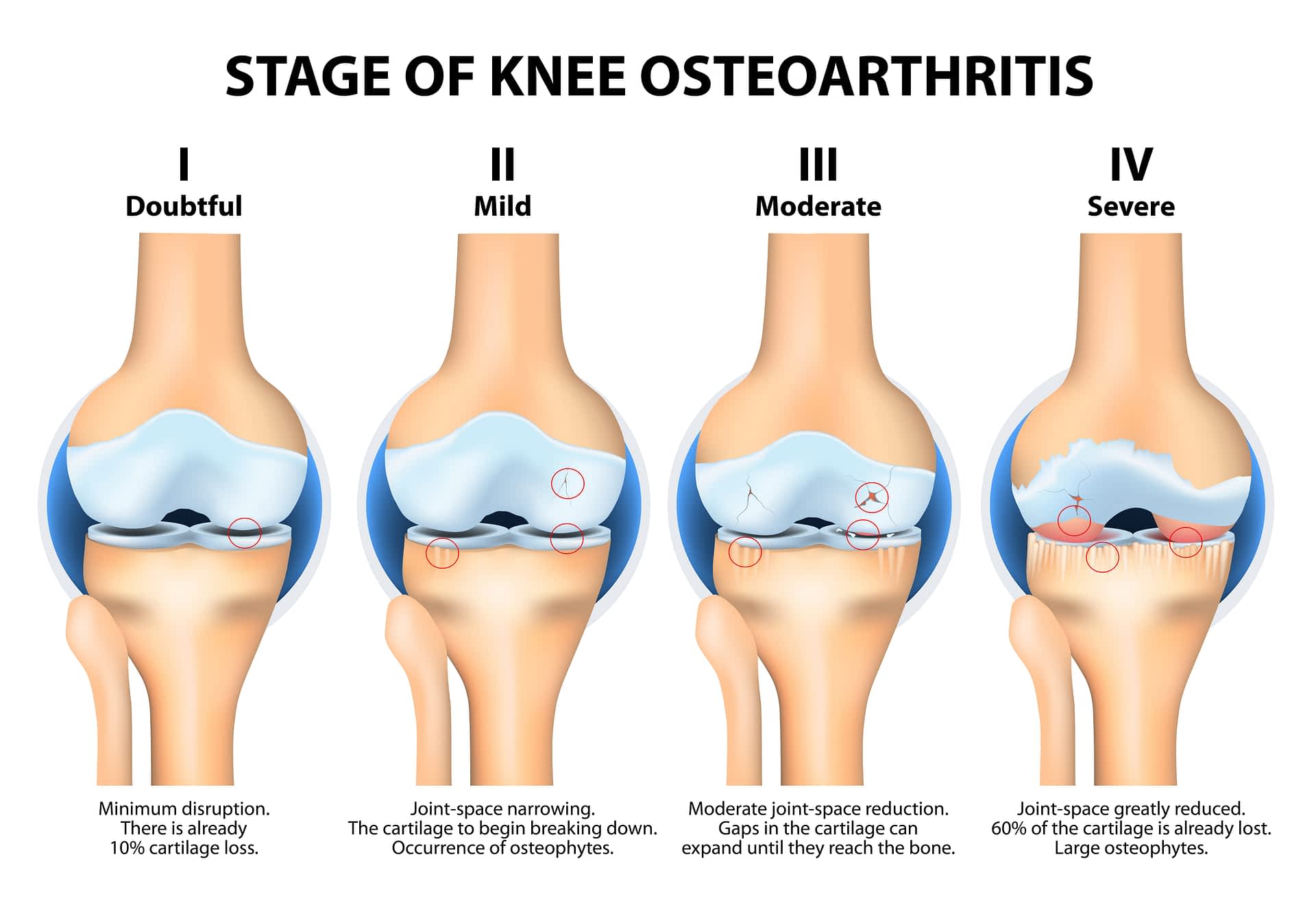 new research knee osteoarthritis